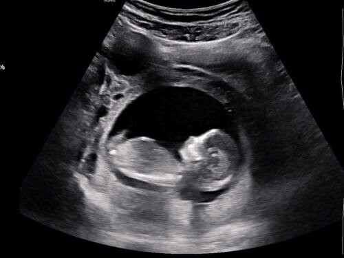 How Does an Ultrasound Work?